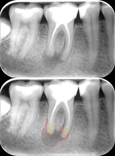 Ízületek fáj a fogak morzsolódnak - Rágóízületi gyulladás (TMJ): tünetek és kezelés | Oral-B